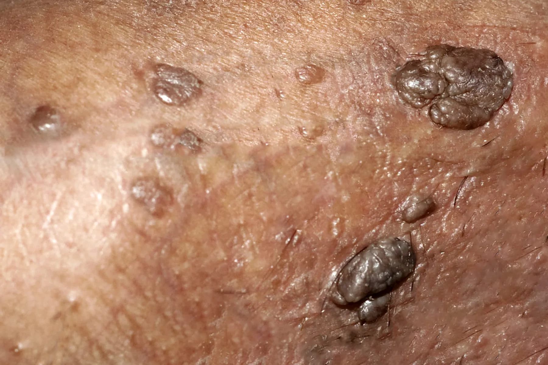 Cover Image for Erkeklerde HPV (Kondilom): Genital Siğil Nedir? Bulaşma Yolları, Belirtileri, Tedavisi ve Korunma Yöntemleri