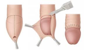 Cover Image for Sünnet Nedir? Ne Zaman ve Kim Tarafından Yapılır? Teknikleri, Anestezi Türleri, Riskleri ve Faydaları