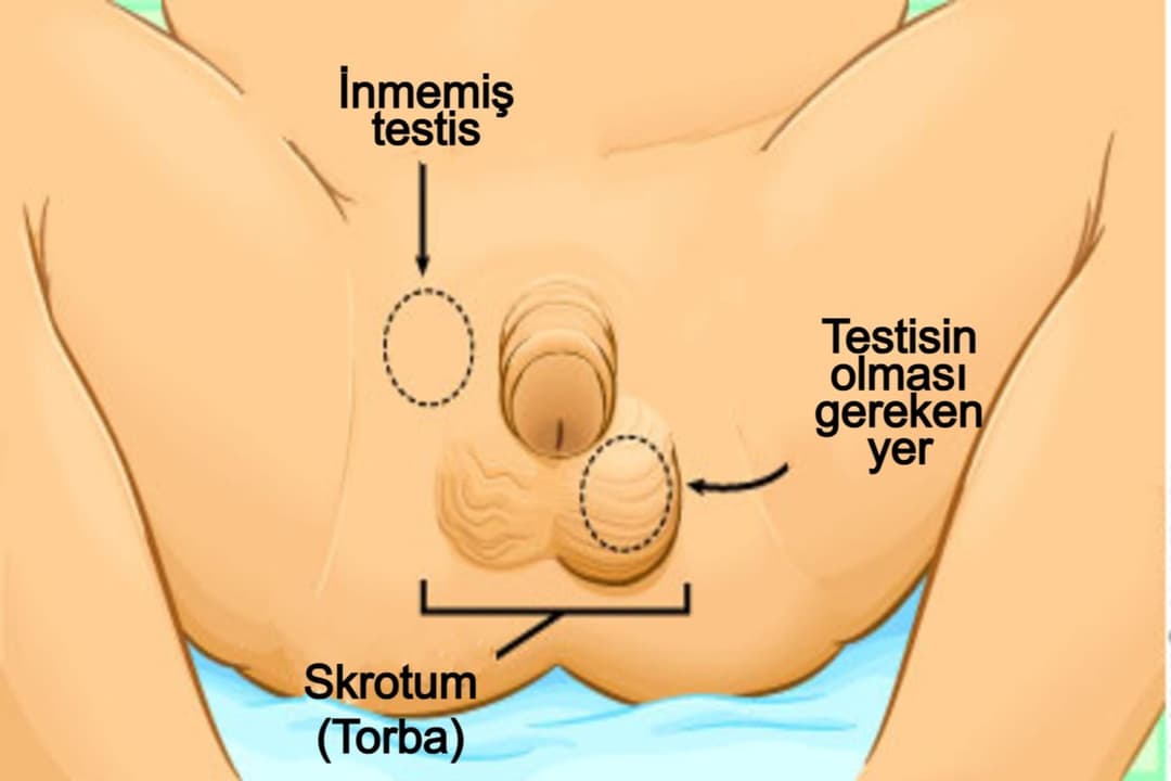 Cover Image for İnmemiş testis (kriptorşidizm) ve asansör testis (retraktil testis) nedir?