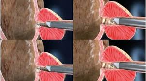 Cover Image for KAPALI PROSTAT AMELİYATI (TUR PROSTAT)