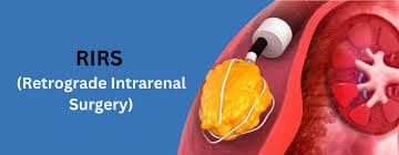 Cover Image for Fleksibl Üreterorenoskopi