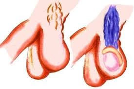 Cover Image for Varikosel Nedir? Nasıl Tedavi Edilir?